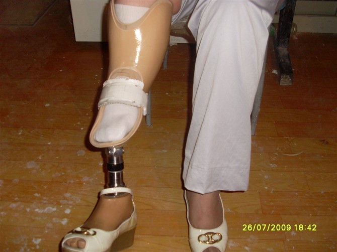 畸形腿、長短腿-2(圖1)