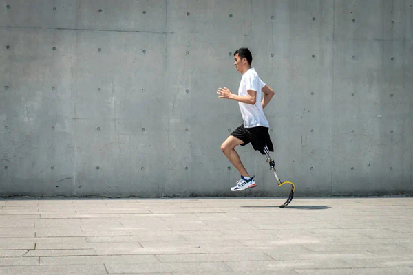 假肢患者如何在短時間內做好殘肢定型?(圖1) 假肢廠家